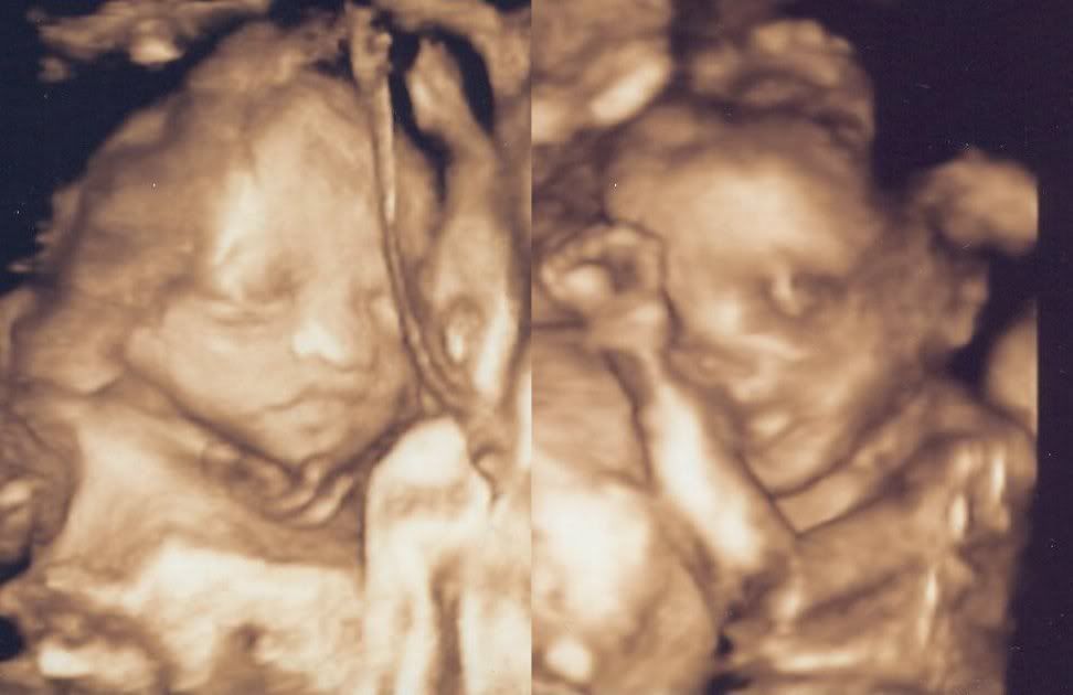 3d ultrasound pictures of twins. Here#39;s my babies in 3d at 24