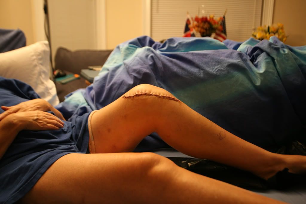 IMAGE: http://i233.photobucket.com/albums/ee24/FatAlbert-UK/KneeOp-1.jpg