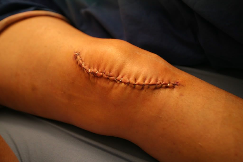 IMAGE: http://i233.photobucket.com/albums/ee24/FatAlbert-UK/KneeOp-2.jpg