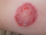 Ringworm in Kids - Diagnosis and Treatment - Verywell